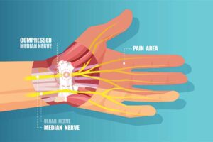 Carpal Tunnel Syndrome and Massage Therapy